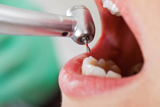 Best Dentist for Tooth Abscess  in Aragon, GA